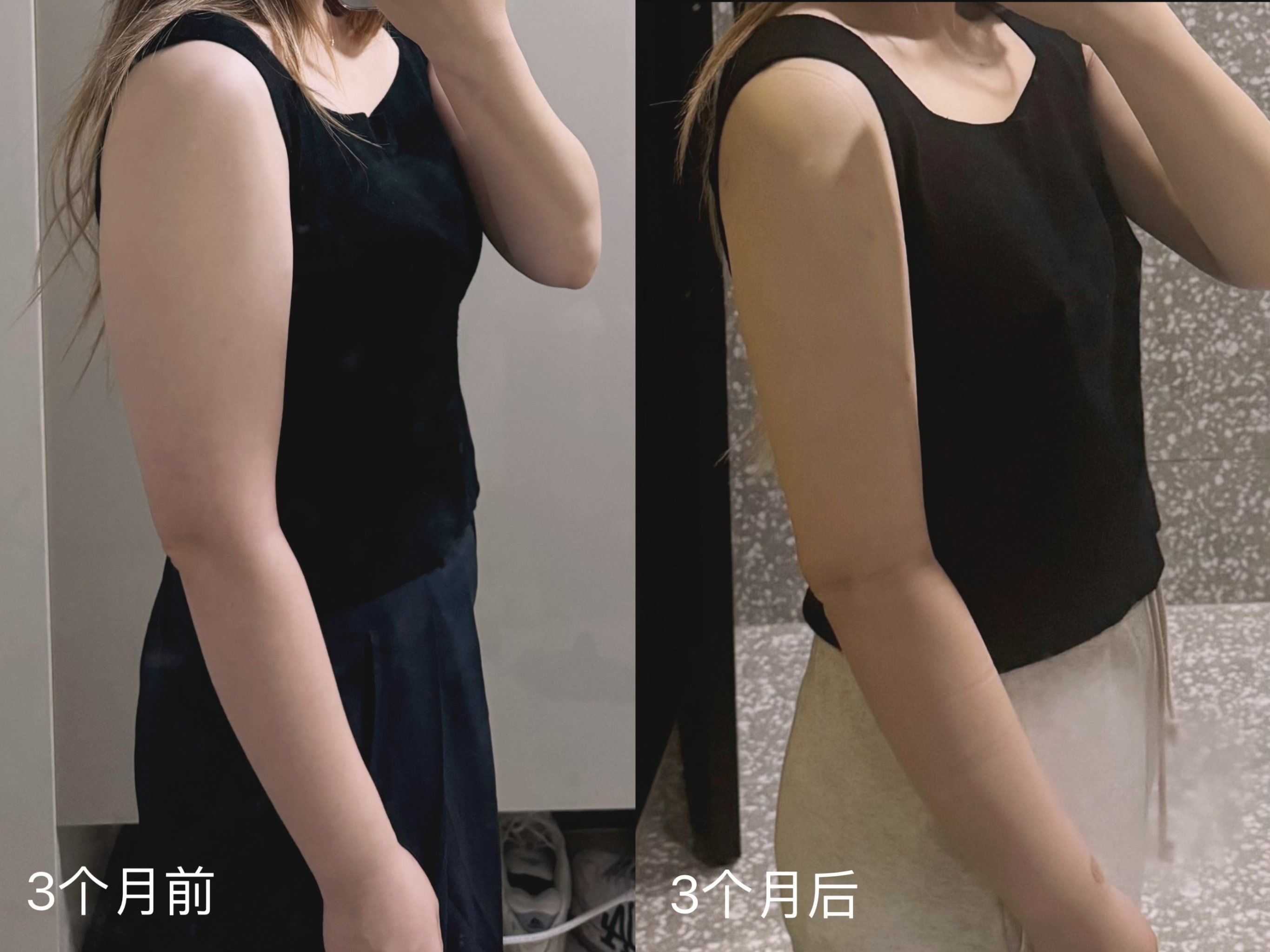 手臂吸脂3个月对比