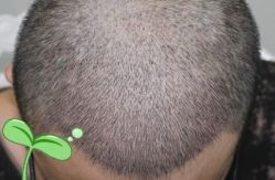 -大麦微针植发丨全国连锁