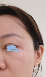 体验后-海涛医疗美容·面部抗衰·注射美鼻