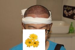-大麦微针植发丨全国连锁