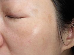-丽美妍医疗美容·皮秒·立体分层抗衰