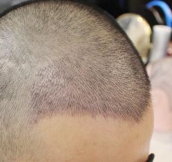 -大麦微针植发丨全国连锁