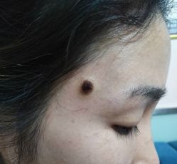 -北京美痣堂古方祛痣斑疣瘊
