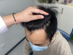 -大麦微针植发全国连锁