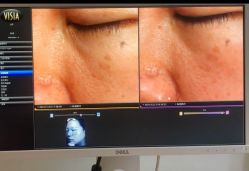 -苑苑vbeauty科技美容SPA