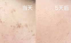 体验后-小忠丽格医美