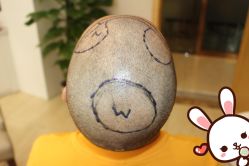 点击看大图 -大麦微针植发丨全国连锁