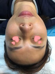 体验前-More摩尔医美の注射线雕光电中心