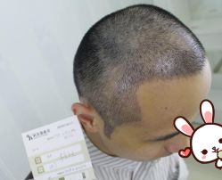 -大麦微针植发丨全国连锁