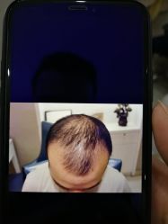 -大麦微针植发全国连锁