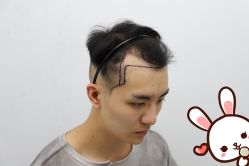 -大麦微针植发丨全国连锁