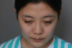 体验前-北京米扬丽格医疗美容·联合丽格鼻整形中心