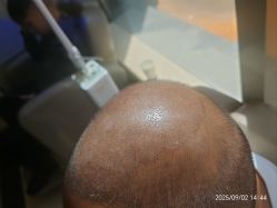 -碧莲盛·不剃发植发