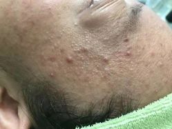 -苗医生草本科技祛痘