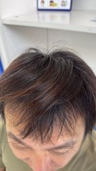 -大麦微针植发全国连锁