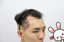 -大麦微针植发丨全国连锁