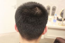 点击看大图 -大麦微针植发丨全国连锁