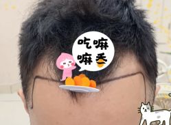 -大麦微针植发全国连锁