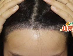 -大麦微针植发全国连锁
