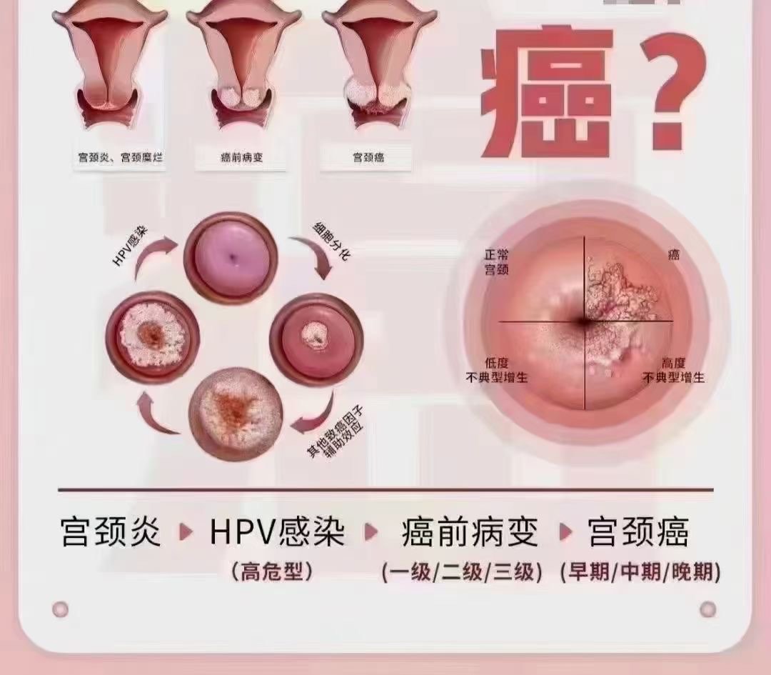 宫颈糜烂会痛吗图片