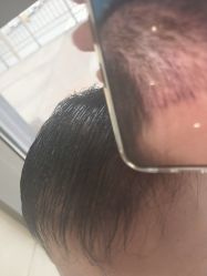 -碧莲盛·不剃发植发