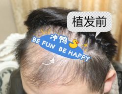 -大麦微针植发全国连锁