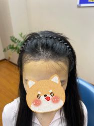 -大麦微针植发全国连锁