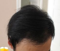 -大麦微针植发丨全国连锁