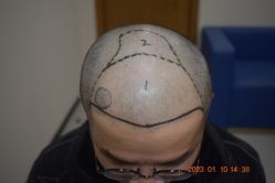 -大麦微针植发全国连锁