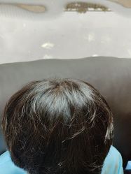 -碧莲盛·不剃发植发