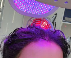 -大麦微针植发全国连锁