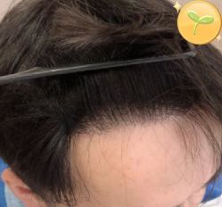 -大麦微针植发丨全国连锁