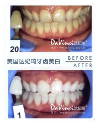 牙齿美白-光SPA科技美肤