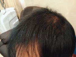 -碧莲盛·不剃发植发