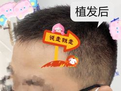 -大麦微针植发全国连锁