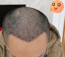 -大麦微针植发丨全国连锁