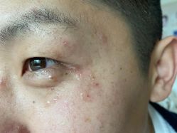 -爱莎扁平疣·汗管瘤·斑痣中心