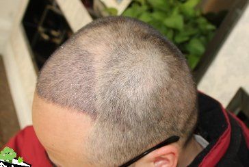 -大麦微针植发丨全国连锁