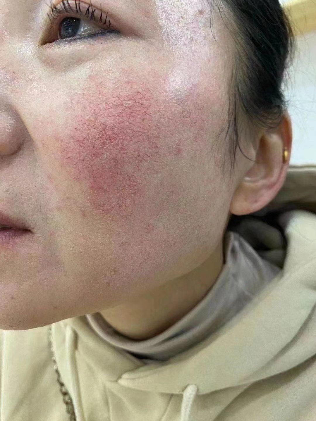 毛细血管为什么会扩张?为什么在线 毛细血管为什么会扩张?为什么在线