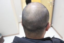 点击看大图 -大麦微针植发丨全国连锁