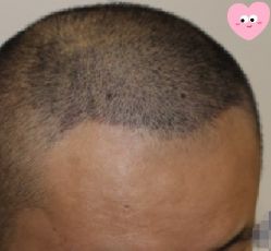 -大麦微针植发丨全国连锁