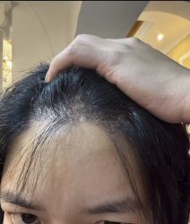 -大麦微针植发丨全国连锁