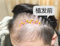 -大麦微针植发全国连锁