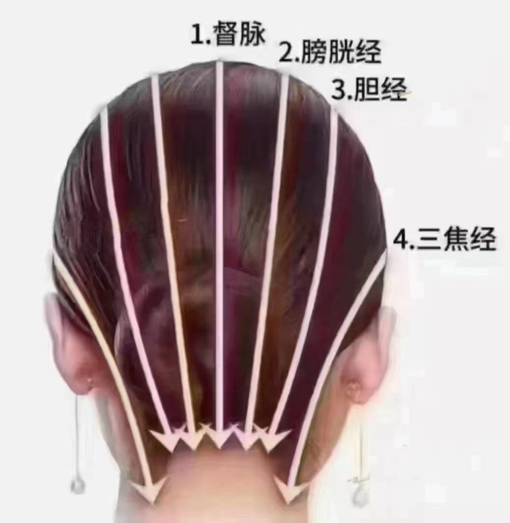 头部刮痧好处:刮痧属于中医治疗办法