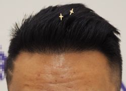 -大麦微针植发全国连锁