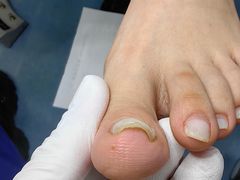 -Andrew指甲专科灰指甲·甲沟炎矫正·3D步态矫形鞋垫定制(上海法华镇路旗舰店)