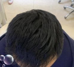 -大麦微针植发丨全国连锁