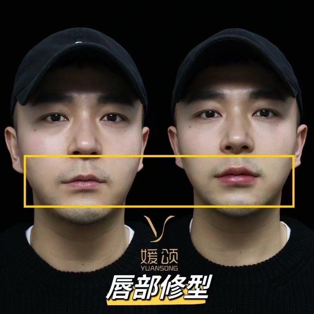 男士丰唇了解一下