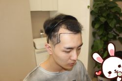 点击看大图 -大麦微针植发丨全国连锁