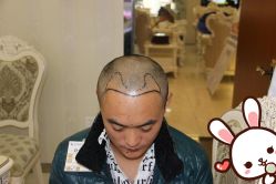 点击看大图 -大麦微针植发丨全国连锁